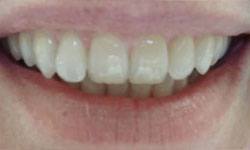 Discolored teeth before porcelain veneer treatment
