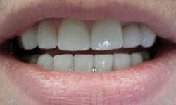 Flawless healthy smile after dental crowns and bridges