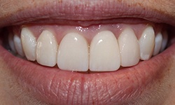Flawless smile after dental implant tooth replacement