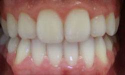 Perfected smile after Invisalign treatment