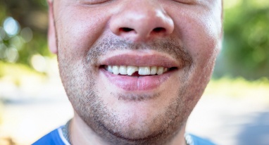 Man with chipped front tooth