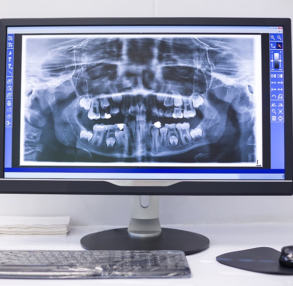 X-rays of smile before dental implant tooth replacement