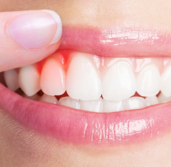 Smile with damaged soft tissue discovered during oral cancer screening