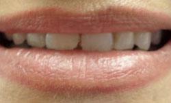 Cracked and damaged teeth before porcelain veneers