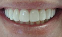 Picture perfect smile after porcelain veneer treatment