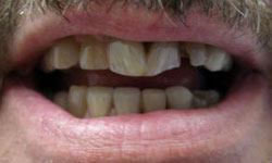 Broken and damaged top teeth before porcelain veneers