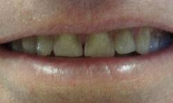 Decayed and discolored teeth before porcelain veneer treatment