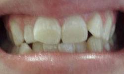 Oversize front teeth before porcelain veneers