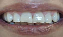Cracked and worn teeth before porcelain veneers