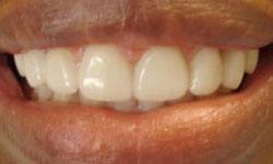 Perfectly aligned smile after porcelain veneers