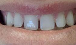 Improperly spaced teeth before porcelain veneer treatment