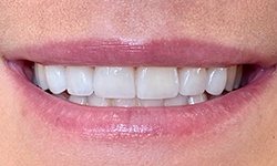 Perfectly aligned smile after porcelain veneers