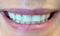 Unevenly spaced teeth before porcelain veneers