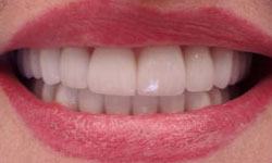 Smile after dental crowns and bridges treatment