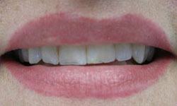 Smile before dental crowns and bridges treatment