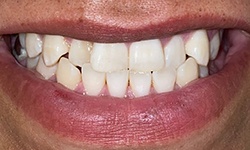 Improperly spaced teeth before porcelain veneer treatment