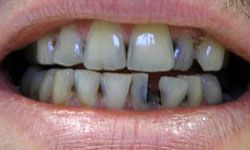 Decayed damaged and missing teeth before dental crowns and bridges