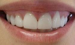 Closed gap between front teeth after dental crown restoration