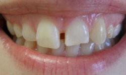 Space between front teeth before dental crown restoration