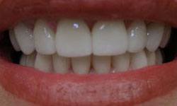 Healthy smile after dental crown restoration