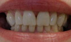Decayed smile before dental crown restoration