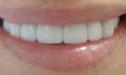 Bright white smile after dental crown restoration