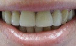 Yellowed smile before dental crown restoration