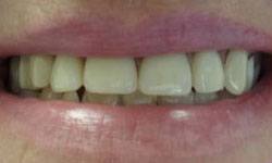 Discolored teeth before dental crowns