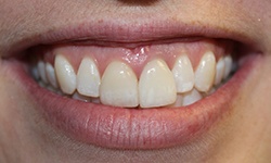 Oversized bront teeth before dental implant tooth replacement
