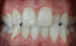 Crowded teeth before Invisalign treatment