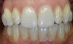 Gorgeous smile after Invisalign treatment