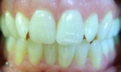 Misaligned teeth before Invisalign treatment