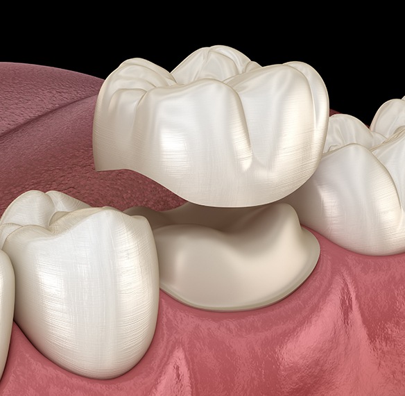 Animate dental crown placement process