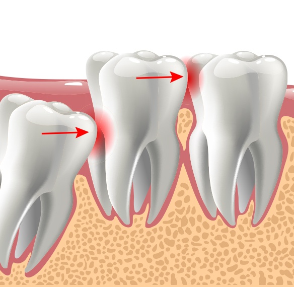 Animated smile with impacted tooth