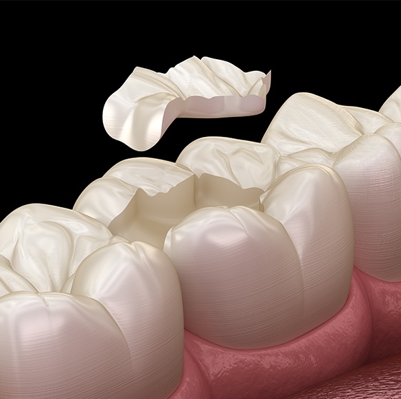 Animated tooth colored filling placement