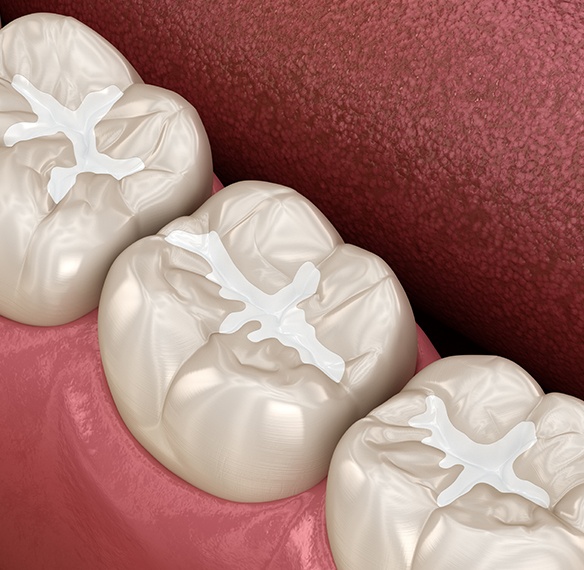 Three animated teeth with tooth colored fillings