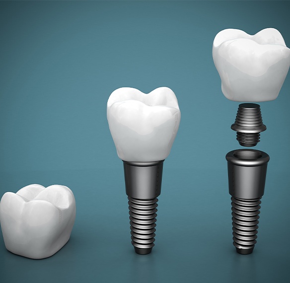 Animated steps in the dental implant tooth replacement process