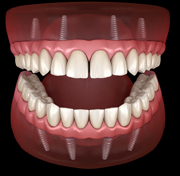 Animated denture placement