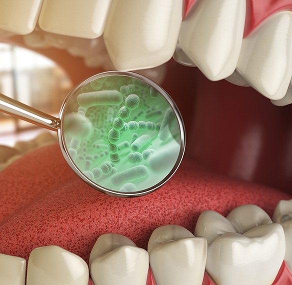 Aniamted smile with visible oral bacteria that cause gum disease