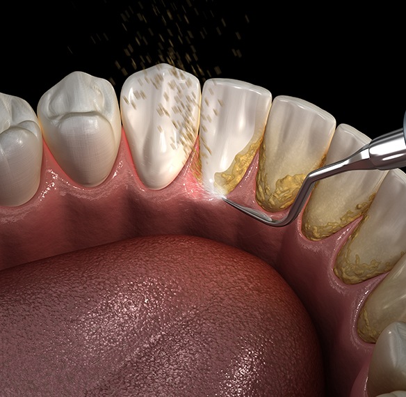 Animated smile receiving periodontal therapy