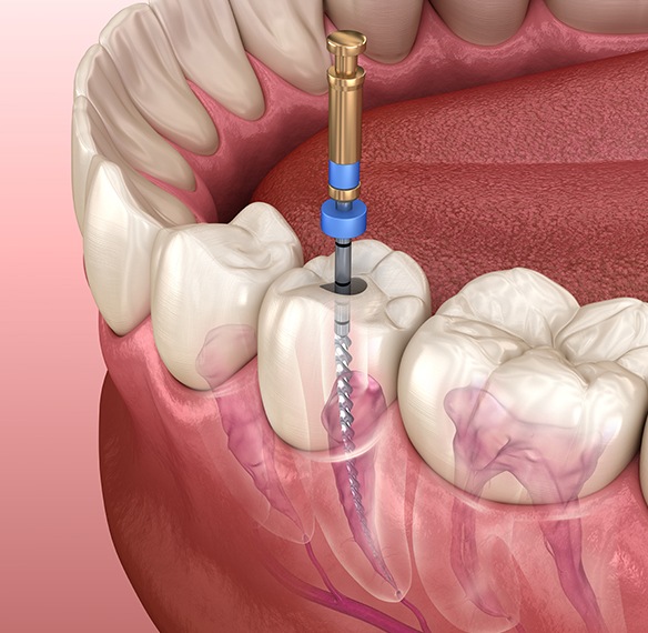Animated root canal treatment process
