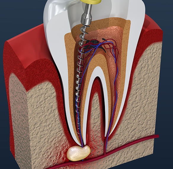 Animated inside of tooth during root canal therapy