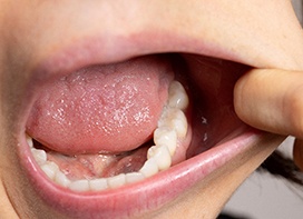Person using finger to show back teeth