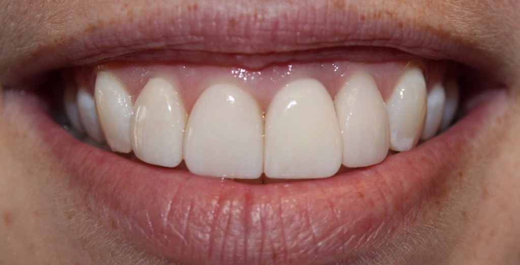 Dental Implants, El Reno, OK General & Family Dentistry in El Reno