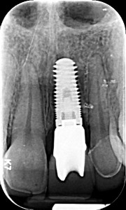 Image 2 After Dental Implant