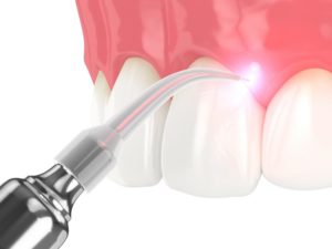 close-up of gums receiving laser dentistry in El Reno 